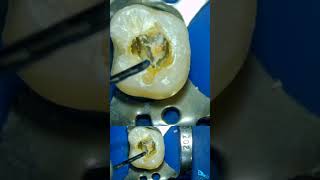 guttapercha Removal Demo using D RETREATMENT files [upl. by Adnohsar190]