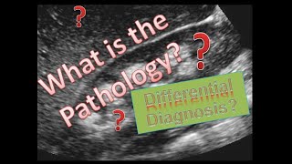 What is the pathology ultrasound nephrocalcinosis [upl. by Roswell]