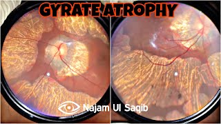 Retinochoroidal Gyrate Atrophy With Myopia [upl. by Eedyaj]