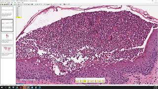 Acute generalized exanthematous pustulosis AGEP pustular psoriasis and SneddonWilkinson [upl. by Slavin]