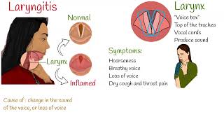 Laryngitis  Symptoms causes and treatment [upl. by Roe]