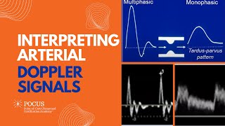 Interpreting Arterial Doppler Signals [upl. by Orlina]