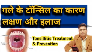 What are Tosillitis Cause Symptoms amp Treatment TONSIL KA ILAJ [upl. by Dirgni326]