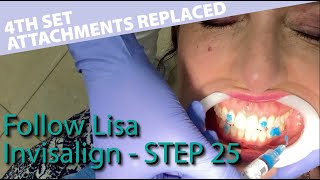 🦷 Invisalign 25  Removal of attachments  4th and final set of overcorrection trays  Follow Lisa [upl. by Oad]