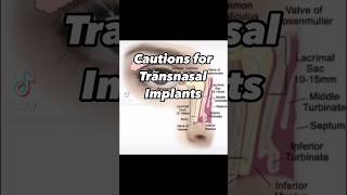 Cautions for Transnasal Implants [upl. by Thessa217]