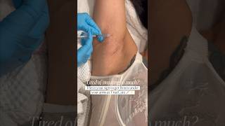 Armpit Botox for Excessive Sweating [upl. by Ydal]