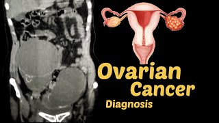 Ovarian Cancer diagnosis  CT SCAN [upl. by Dnalevelc]