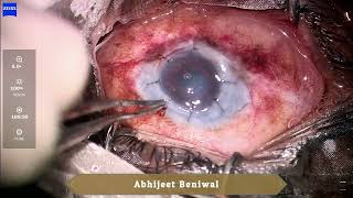 Optical penetrating keratoplasty in Xeroderma Pigmentosum [upl. by Nerval]