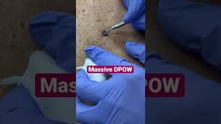 Massive Dilated Pore of Winer DPOW Removal [upl. by Hiller]