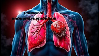 What causes pulmonary embolism Understanding the risks [upl. by Blondelle]