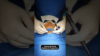 Chin Implant Transformation  Sarayu Clinics beauty [upl. by Errick]