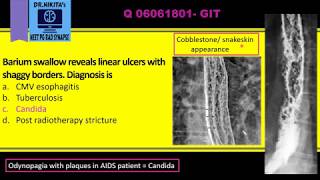 Candida esophagitis Shaggy esophagus [upl. by Eceryt742]