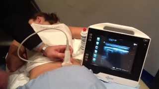 Ultrasound Guided SI Joint Injection  How To [upl. by Anay]