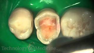 Dental Laser  Crown Prep Extracted [upl. by Awra]