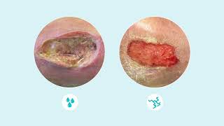 How to assess wound exudate [upl. by Anitnahs798]