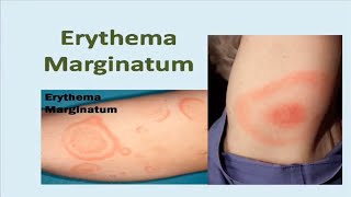 Erythema Marginatum Rash [upl. by Tshombe]