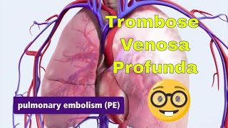 Trombose Venosa Profunda TVP e Embolia Pulmonar EP [upl. by Ricarda]