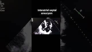 Interatrial septal aneurysm [upl. by Cedar]