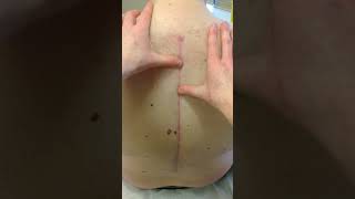 scar massage over spinal surgery site acupuncture [upl. by Dublin]