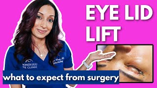 Upper Eyelid Surgery Blepharoplasty What To Know [upl. by Wight]