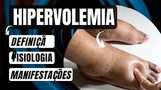 HIPERVOLEMIA Definição Fisiopatologia e Manifestações Clínicas hipervolemia [upl. by Saleem]