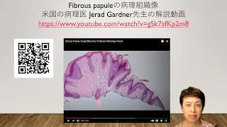 fibrous papule病理組織像 [upl. by Memory855]