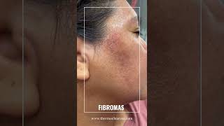 ThermoClear Can Treat Many Skin Imperfections [upl. by Oam]