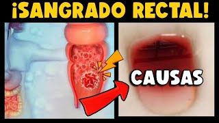 ¡CUIDADO ¿SANGRADO RECTAL ¿CUÁLES SON LAS CAUSAS ¿ES SINÓNIMO DE CÁNCER [upl. by Eellehs]