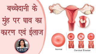 बच्चेदानी के मुंह पर घाव का कारण एवं ईलाज  Cervical Erosion  Cause and Treatment [upl. by Wolff927]