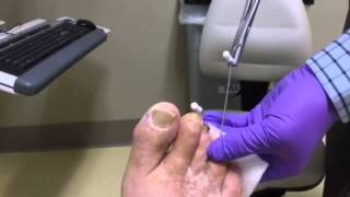 Hammertoe Pin Removal [upl. by Bannerman]