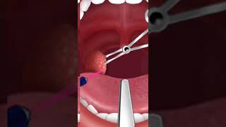 Throt infection  Tonsils shorts SURGERY 3danimation doctor viral [upl. by Eseret]