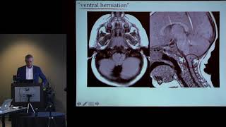 quotDefining Unique Chiari Classificationsquot  Jeffrey P Greenfield MD PhD [upl. by Ahsinert]