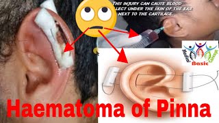 Haematoma of auricle Hematoma of pinna ear emergency with signs  symptoms amp treatmentMedic Surgi [upl. by Niroht]