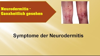 Symptome der Neurodermitis  Ganzmedizin Naturheilpraxis [upl. by Shaw]