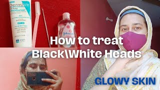 Remove Black and White Heads at home0 CostSuperb ResultsGlass Skinskincareveezeevlogsjenpharm [upl. by Eissel669]