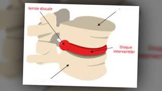 Hernie discale  symptômes et traitements [upl. by Astraea]