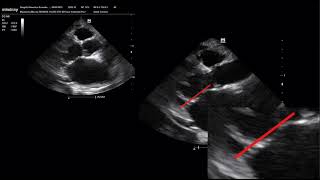 Billowing Mitral Valve  Válvula Mitral Billowing [upl. by Condon]