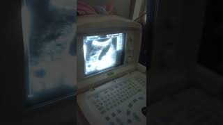 abdominal ultrasound cirrhotic liver cholecystitis with cholelithiasisshortvlog [upl. by Armalla]