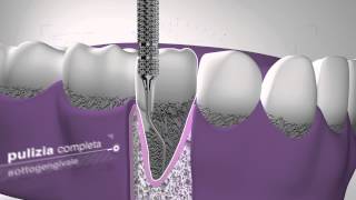 Currettage  Cliniche Dentali Dentix [upl. by Ailalue]