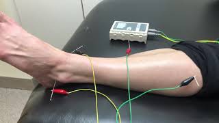 Acupuncture for Plantar Fasciitis at MN Spine and Sport in Woodbury Minnesota [upl. by Lunetta]