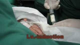 Ambu AuraOnce  Laryngeal Mask  Insertion in real patient [upl. by Afra]