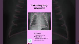 Chest xray adequacy NEONATE [upl. by Fisk]