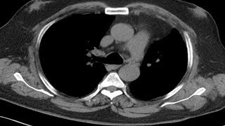 Cross sectional and imaging anatomy of the thorax [upl. by Eldred761]