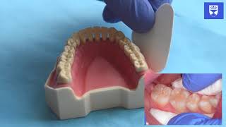 Technique for placing a resin fissure sealant [upl. by Ainimre]