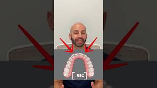 How we make space to straighten overlapping front teeth with Invisalign instead of metal braces [upl. by Akcimahs]