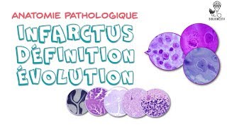 Anatomie Pathologique  Infarctus Définition évolution [upl. by Adnamra]