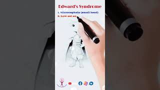 Mnemonic Edwards Syndrome neet fmge usmle biology [upl. by Mussman429]