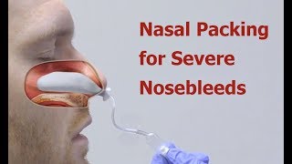 Nasal Packing for Severe Nosebleeds [upl. by Gerhan]