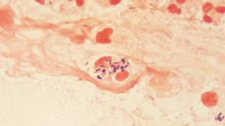 Gram positive and Negative Bacteria inside Pus cell Intracellular Bacteria in Sputum [upl. by Whyte269]