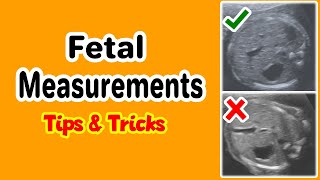 Fetal Measurements Tips and Tricks [upl. by Wahs]